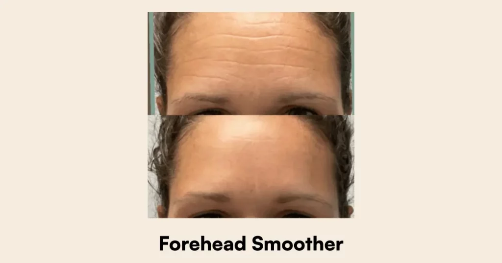 Forehead Smoother